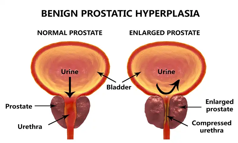 prostatic-hyperplasia